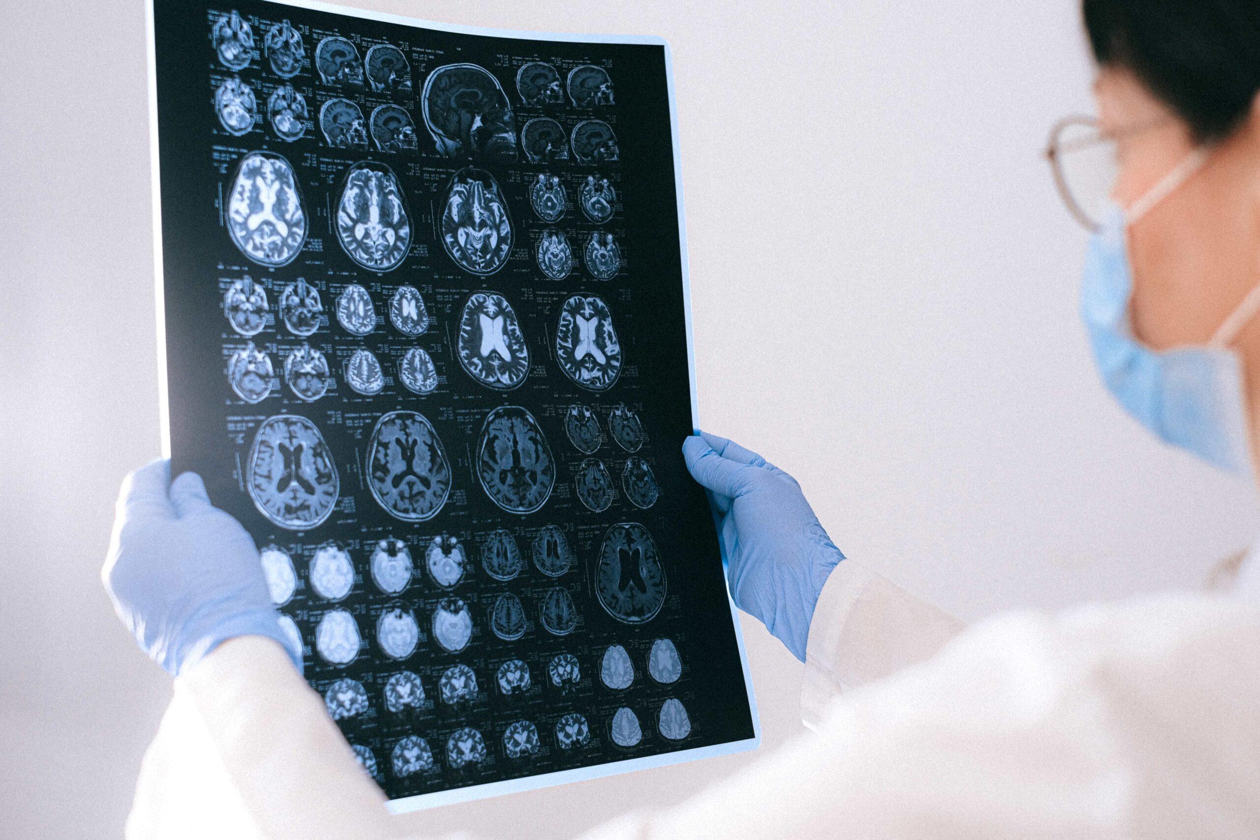 Neurologische Störungen: Entstehung und Milderung - Wissensinsel